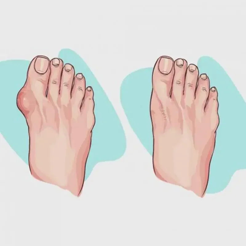 2025 Women Slippers Orthopedic Bunion Corrector - Empire P.E