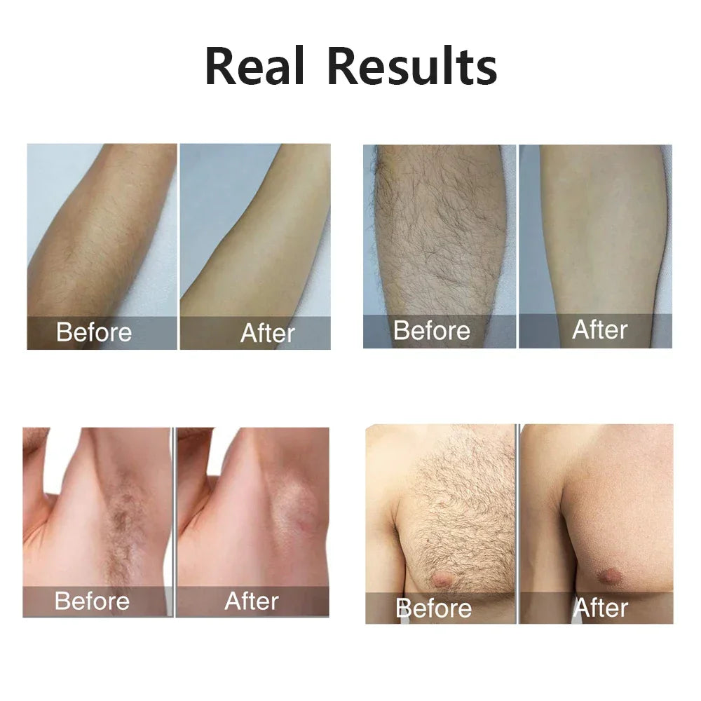 Permanent Laser Epilator Professional Painless Laser Hair Removal - Empire P.E